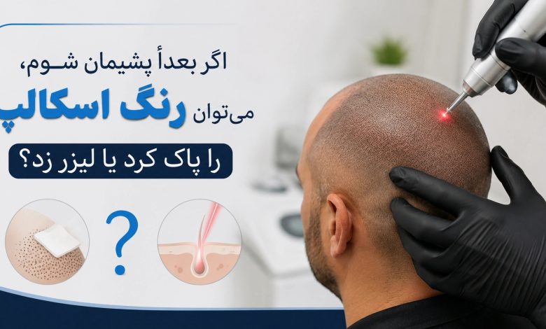 اگر بعداً پشیمان شوم، میتوان رنگ اسکالپ را پاک کرد یا لیزر زد؟